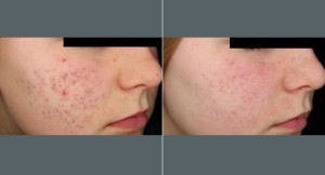 Acne Scar Treatment | Before and After Photos | Dr. Abramson | Atlanta