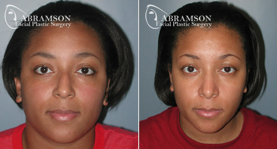 African American Rhinoplasty | Before and After Photos | Dr. Abramson | Atlanta
