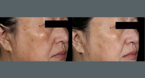 Brown Spots Treatment | Before and After Photos | Dr. Abramson | Atlanta
