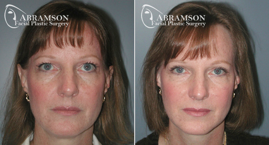 Eyelid Lift | Before and After Photos | Dr. Abramson | Atlanta