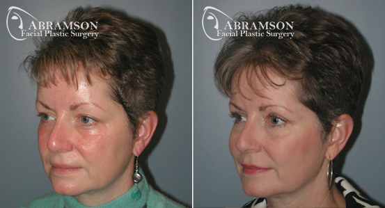 Eyelid Lift | Before and After Photos | Dr. Abramson | Atlanta