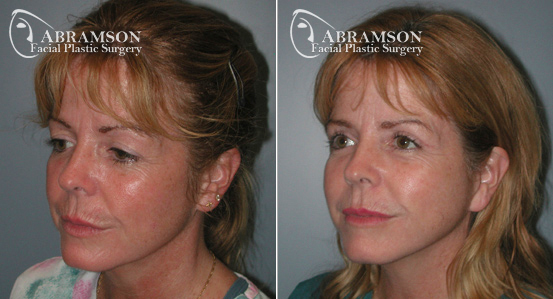 Mini Face Lift | Dr. Abramson Mini Face Lift | Before and After Photos | Dr. Abramson | Atlanta | 12