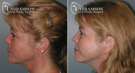 Mini Face Lift | Dr. Abramson Mini Face Lift | Before and After Photos | Dr. Abramson | Atlanta | 13