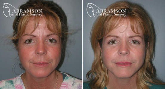 Mini Face Lift | Dr. Abramson Mini Face Lift | Before and After Photos | Dr. Abramson | Atlanta | 14