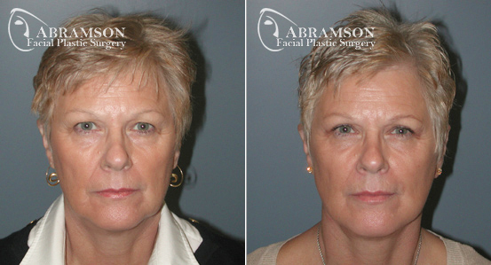 Mini Face Lift | Before and After Photos | Dr. Abramson | Atlanta | 4