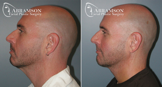 Mini Face Lift | Before and After Photos | Dr. Abramson | Atlanta | 5