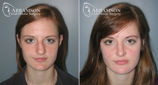 Rhinoplasty | Before and After Photos | Dr. Abramson | Atlanta