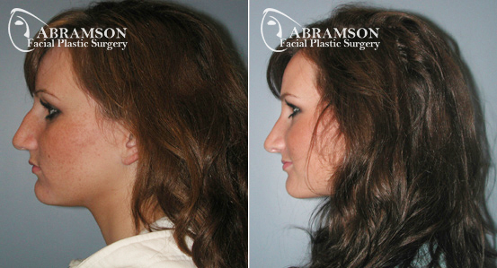 Rhinoplasty | Before and After Photos | Dr. Abramson | Atlanta