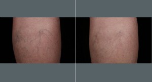 Spider Vein Treatment Legs | Before and After Photos | Dr. Abramson | Atlanta
