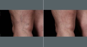 Spider Veins Leg Treatment | Before and After Photos | Dr. Abramson | Atlanta