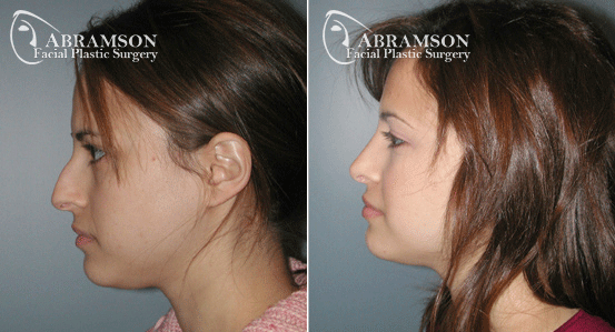 Rhinoplasty gallery